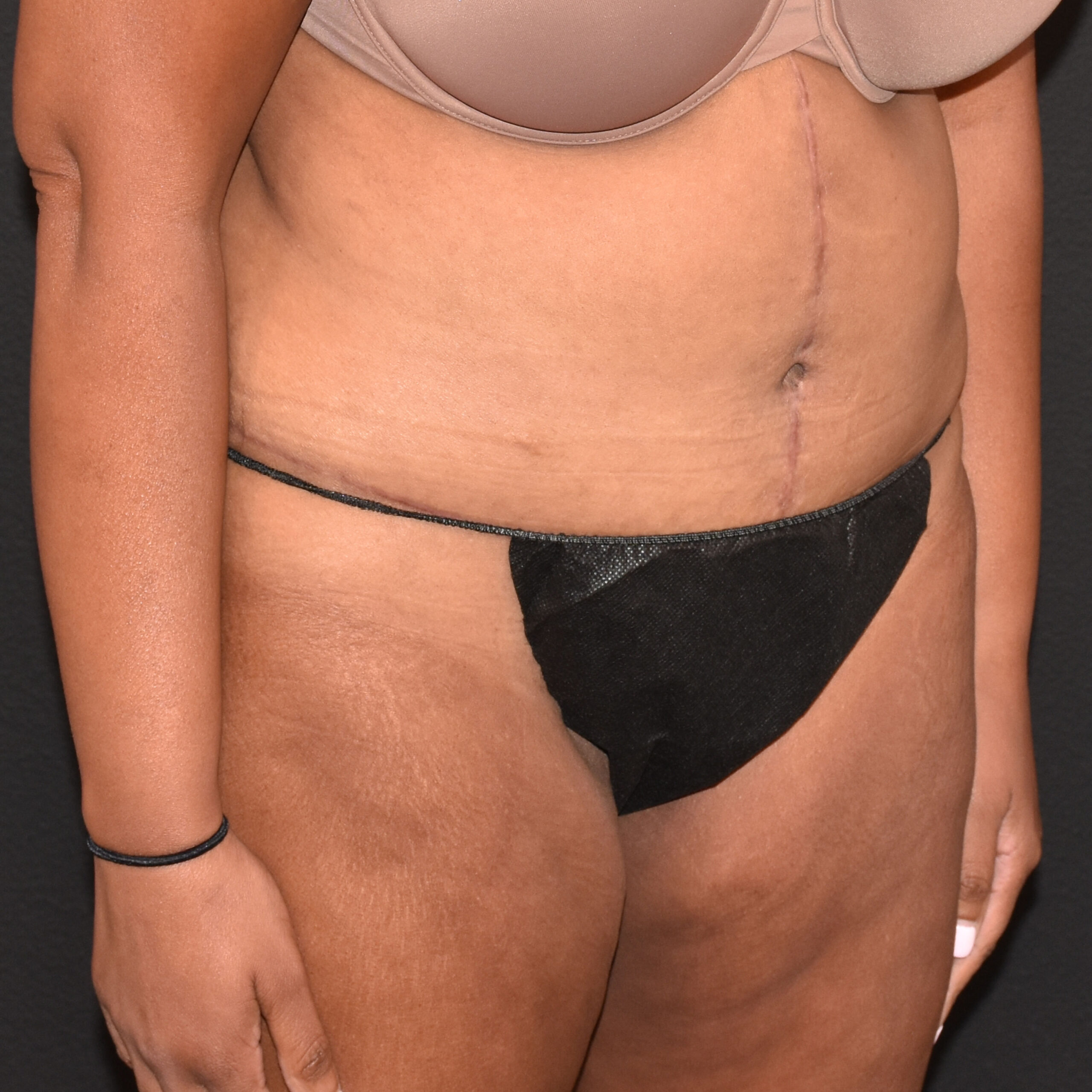 Case--8957 | After Tummy Tuck 2