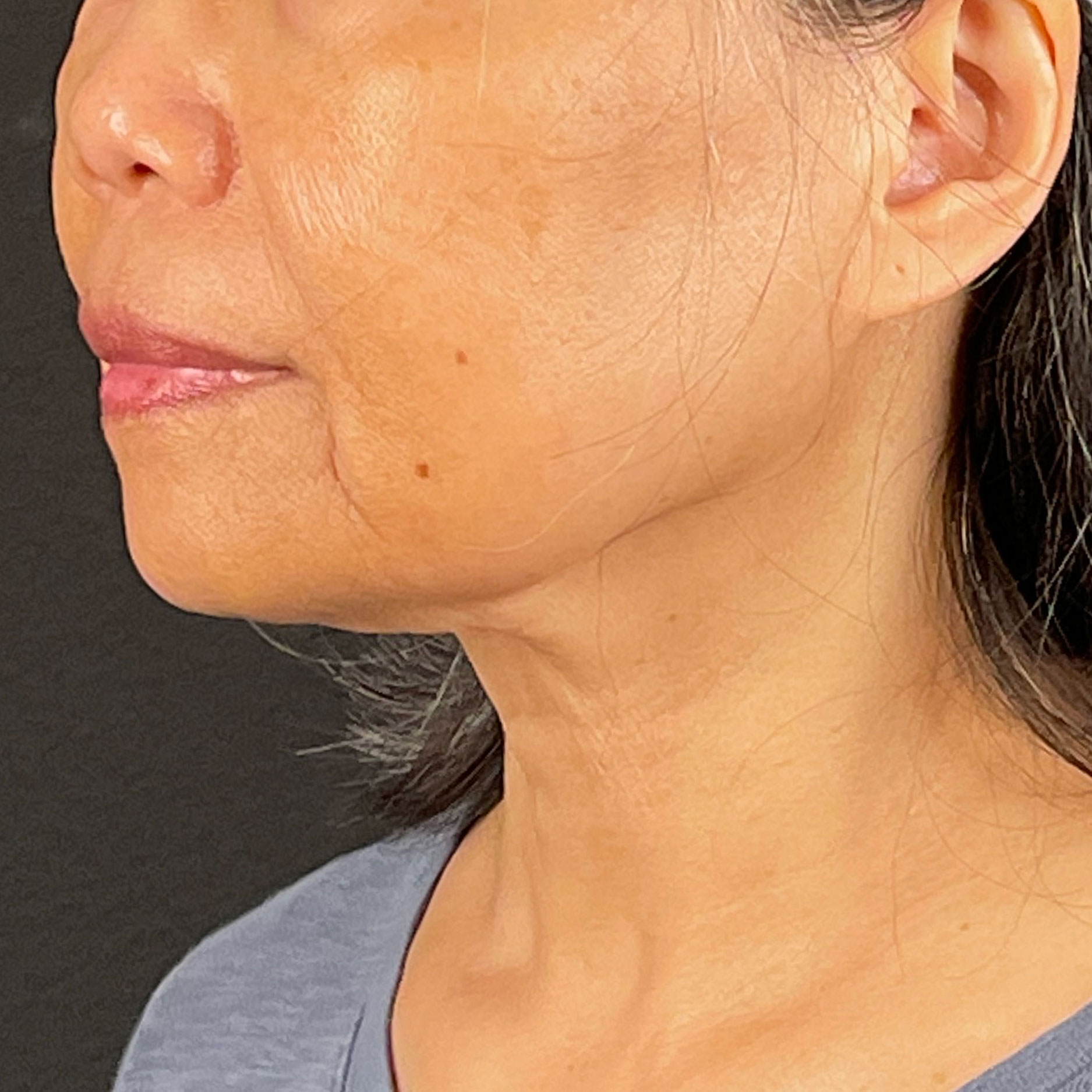 Case--5663 | After Ultherapy and Sofwave