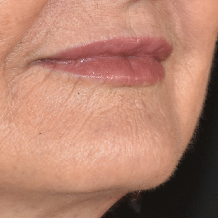 Case--4199 | After Facial Fillers 3