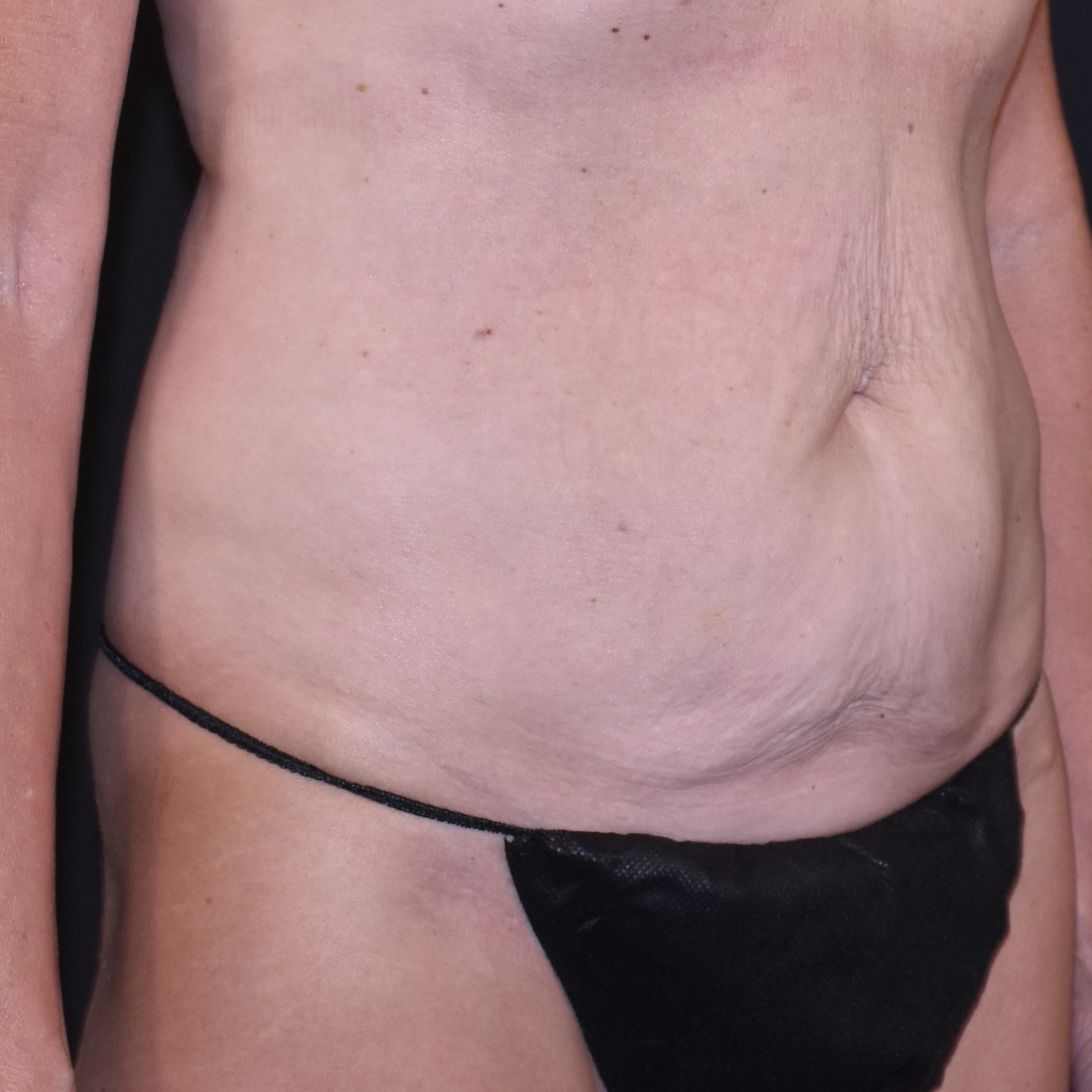 Case--4933 | Before Tummy Tuck 4