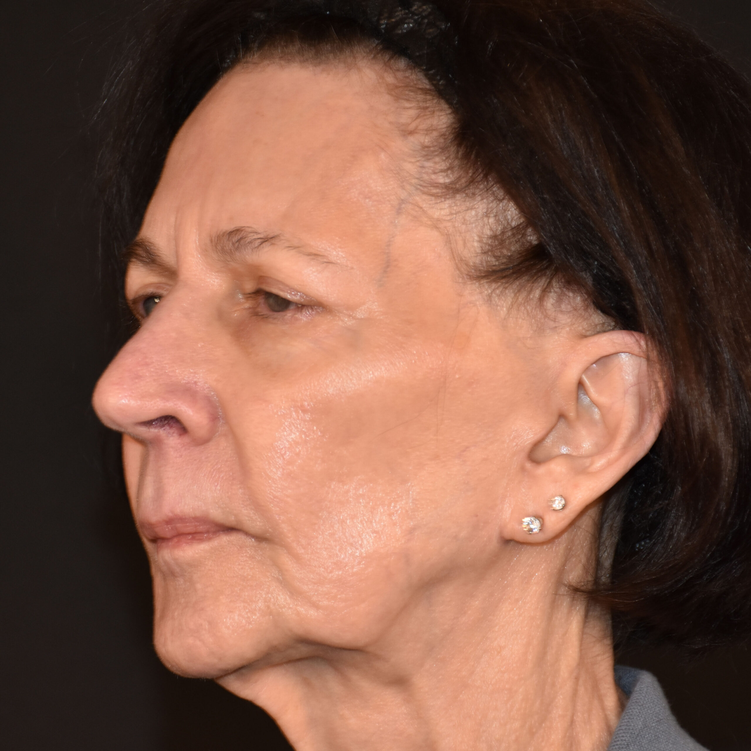 Case--1382 | Before Facial Fillers 4