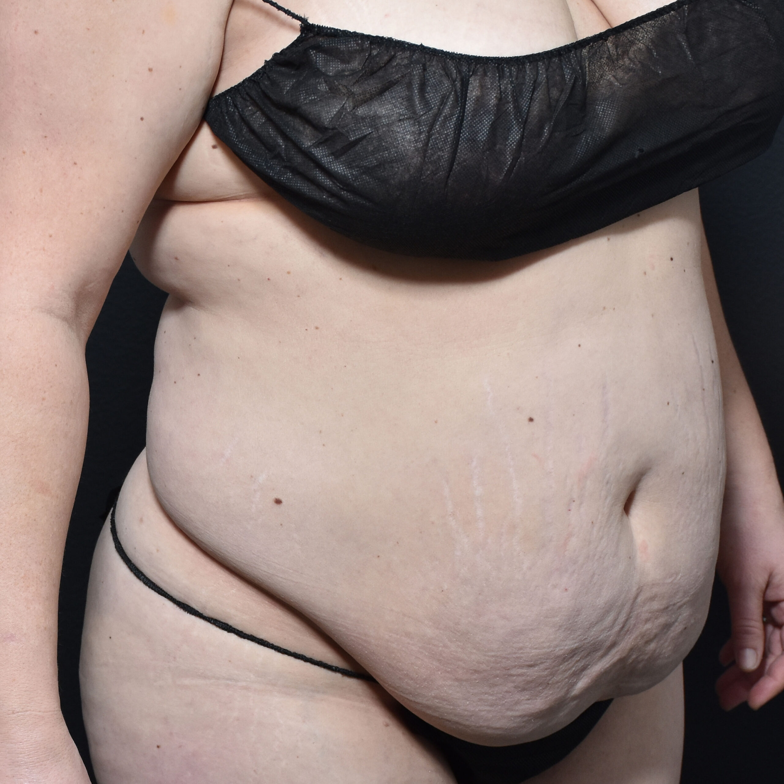 Case--2409 | Before Tummy Tuck 4