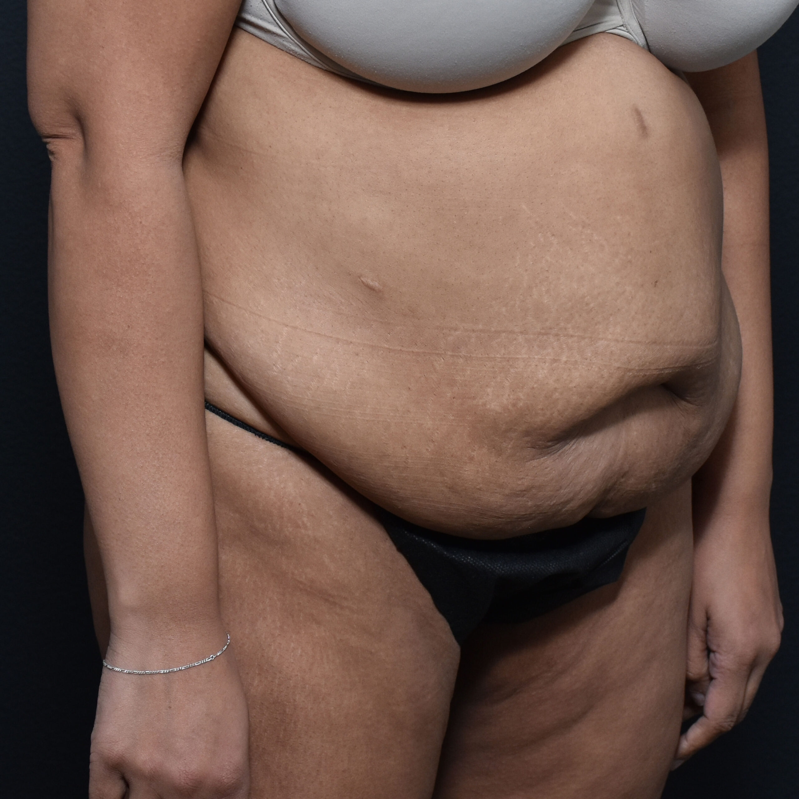 Case--8957 | Before Tummy Tuck 2