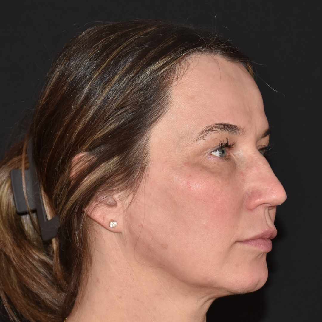 Case--2367 | Before Facial Fillers 2