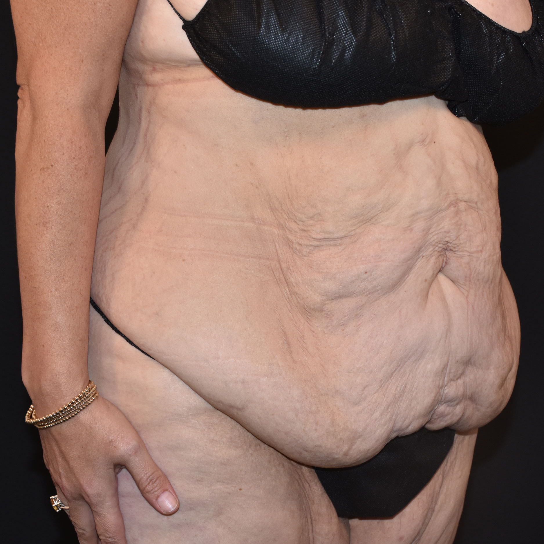 Case--2416 | Before Tummy Tuck 4