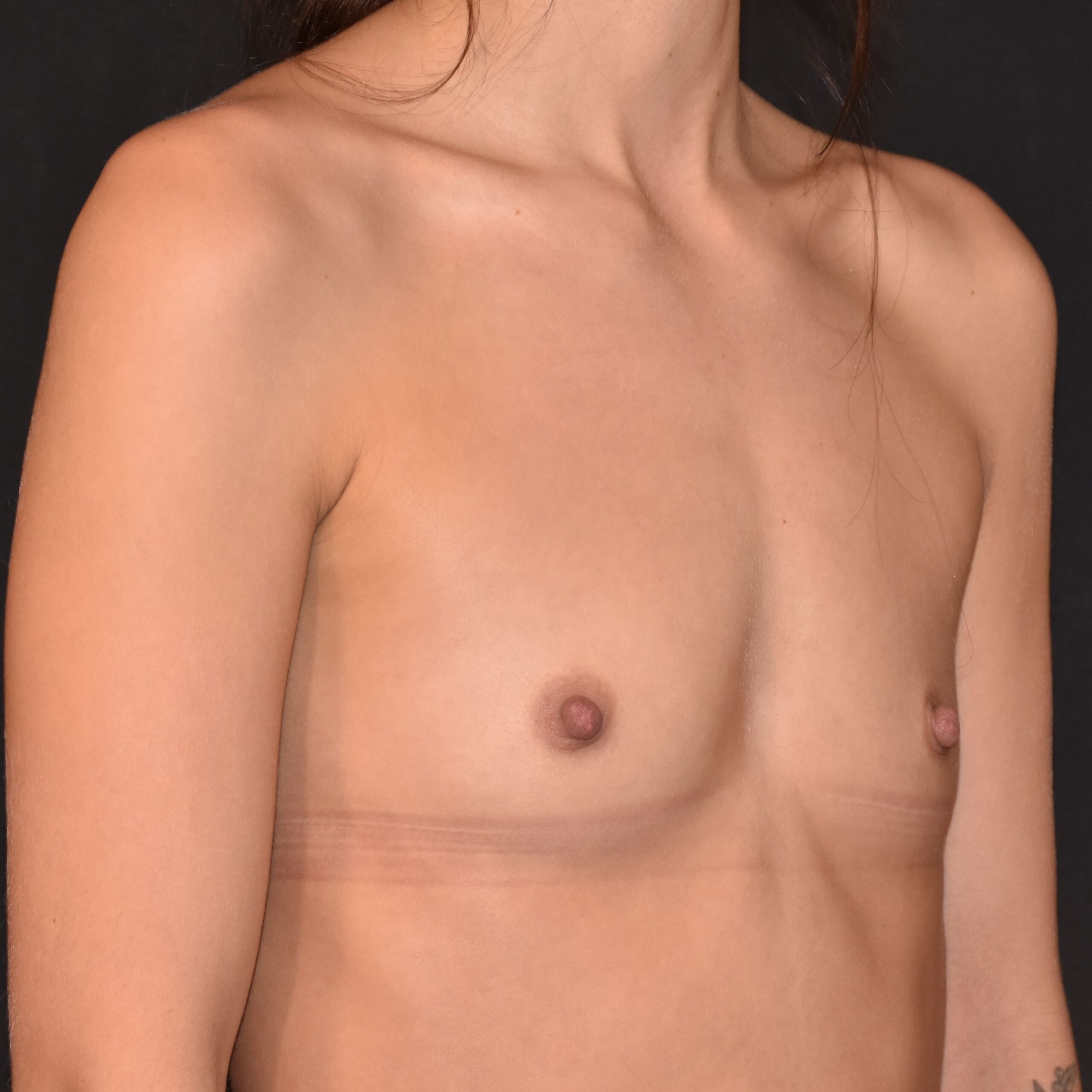Case--9140 | Before Breast Augmentation 2