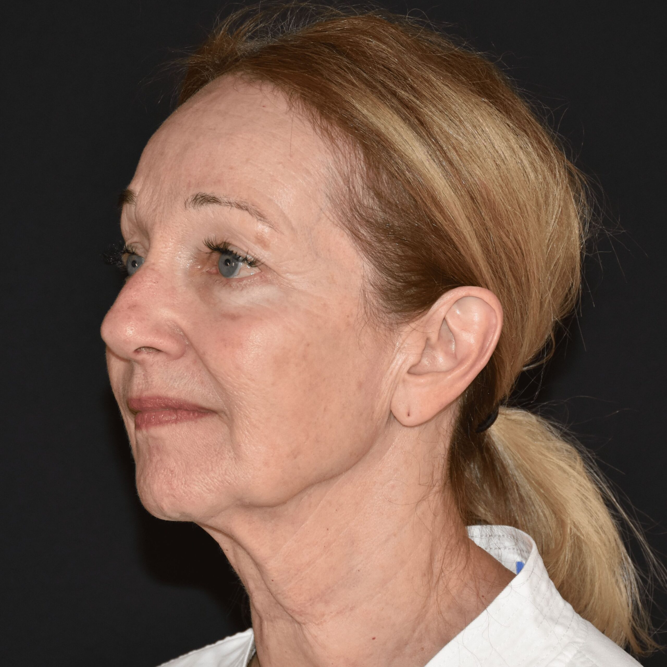 Case--3488 | Before Facelift and Neck Lift 4