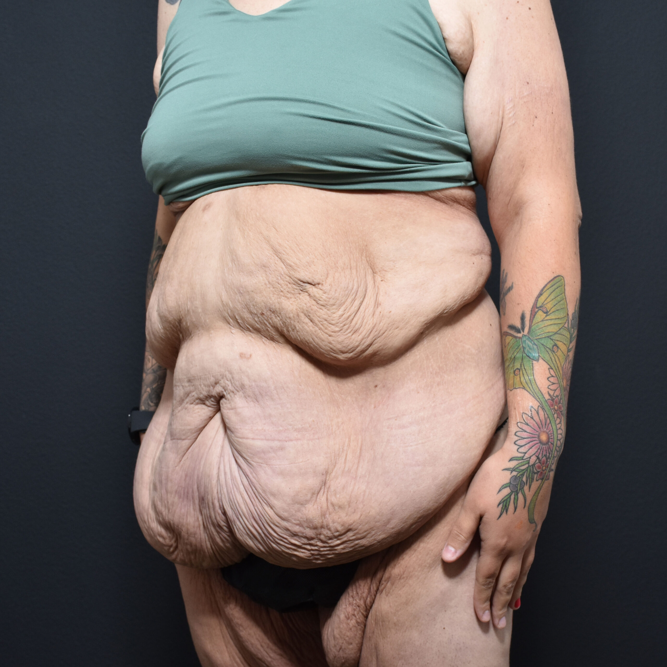 Case--8152 | Before Tummy Tuck 4