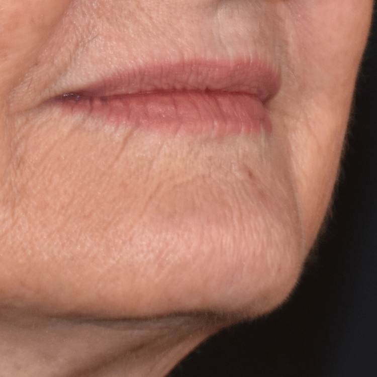 Case--4199 | Before Facial Fillers 3