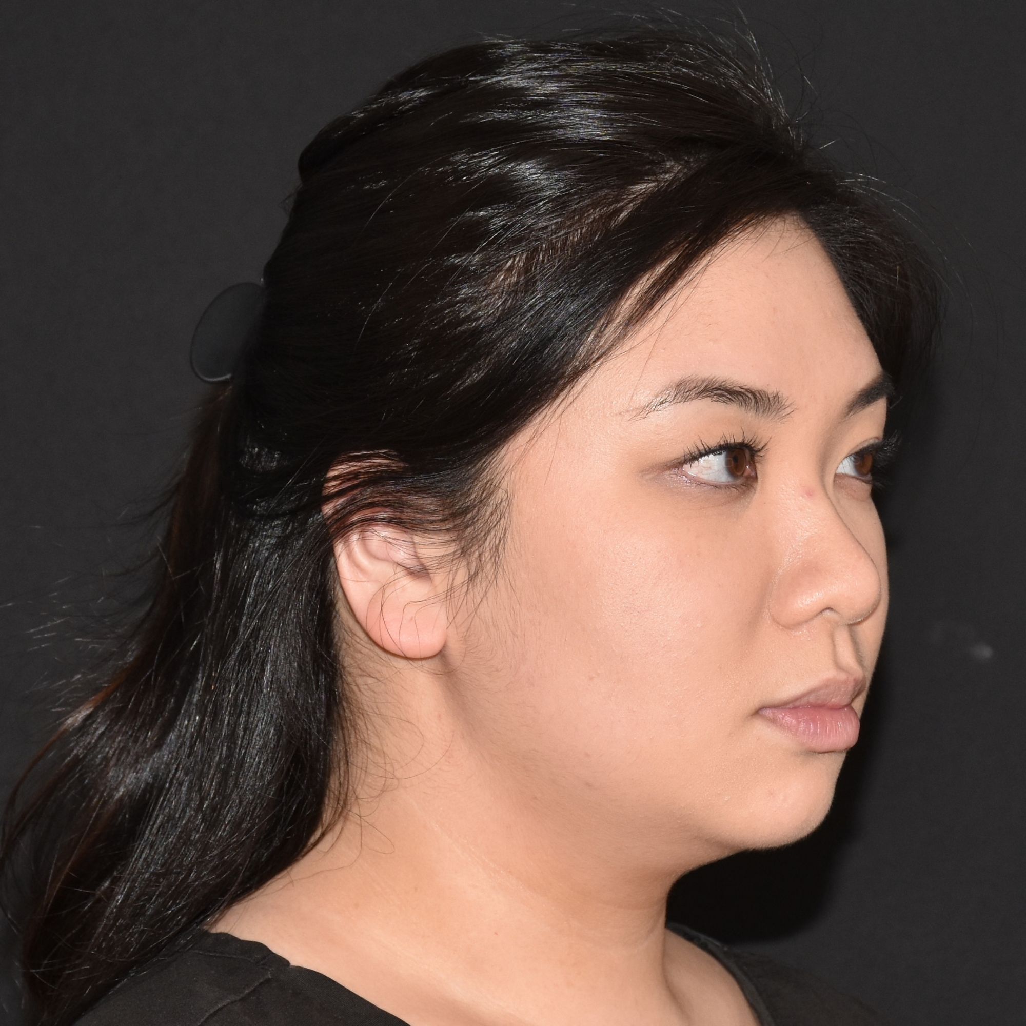 Case--4528 | Before Ultherapy and Sofwave
