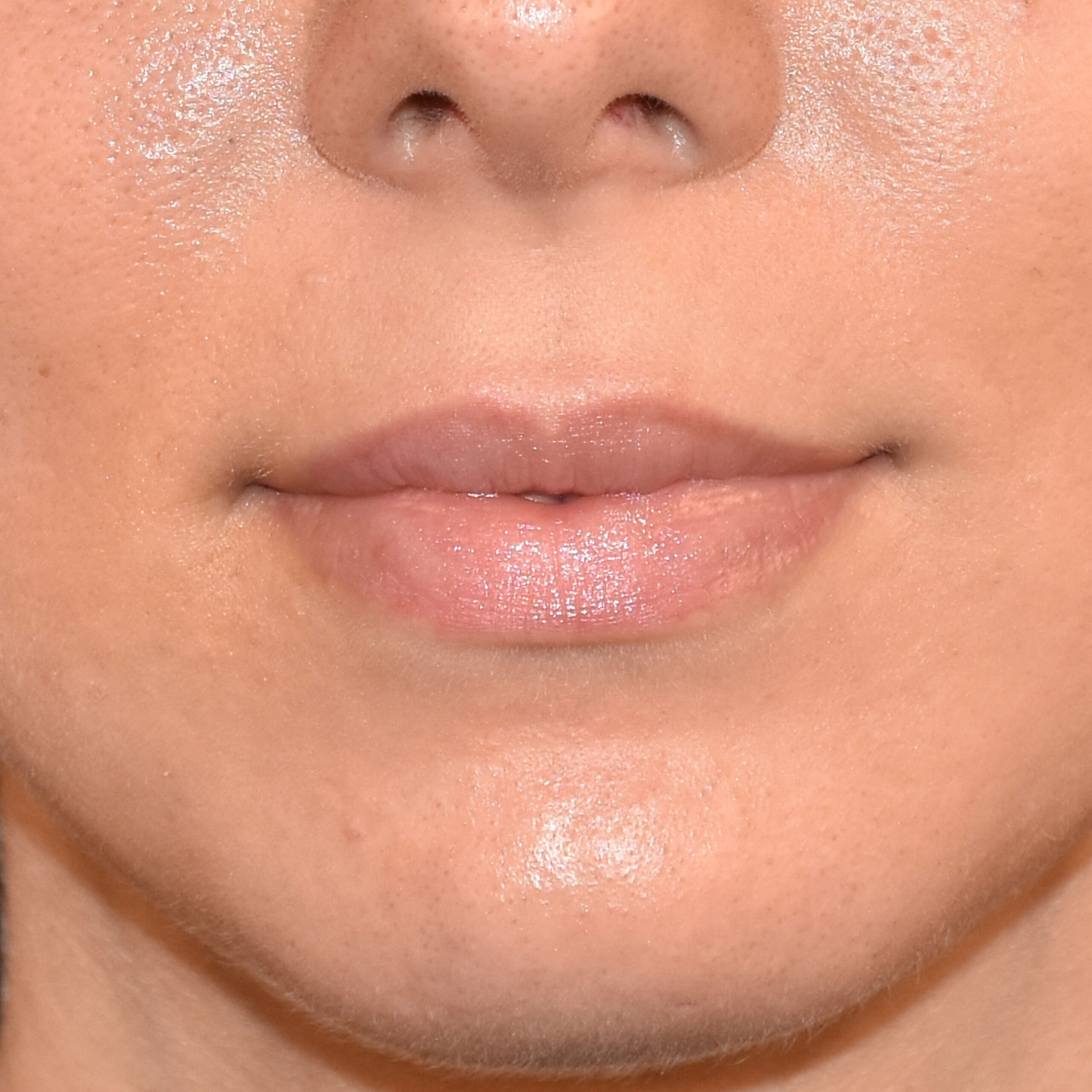 Case--5950 | After Facial Fillers 2