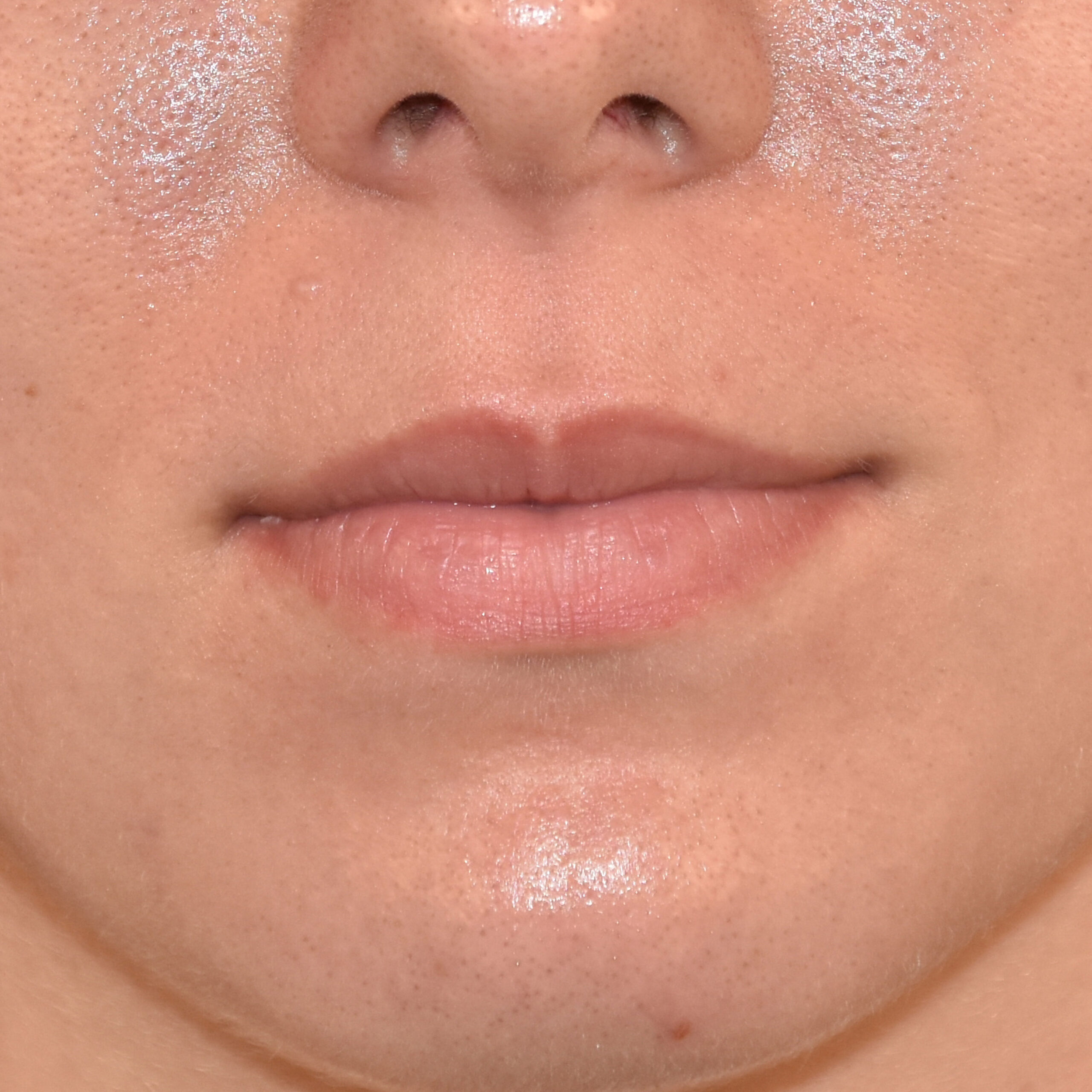 Case--5950 | Before Facial Fillers 2