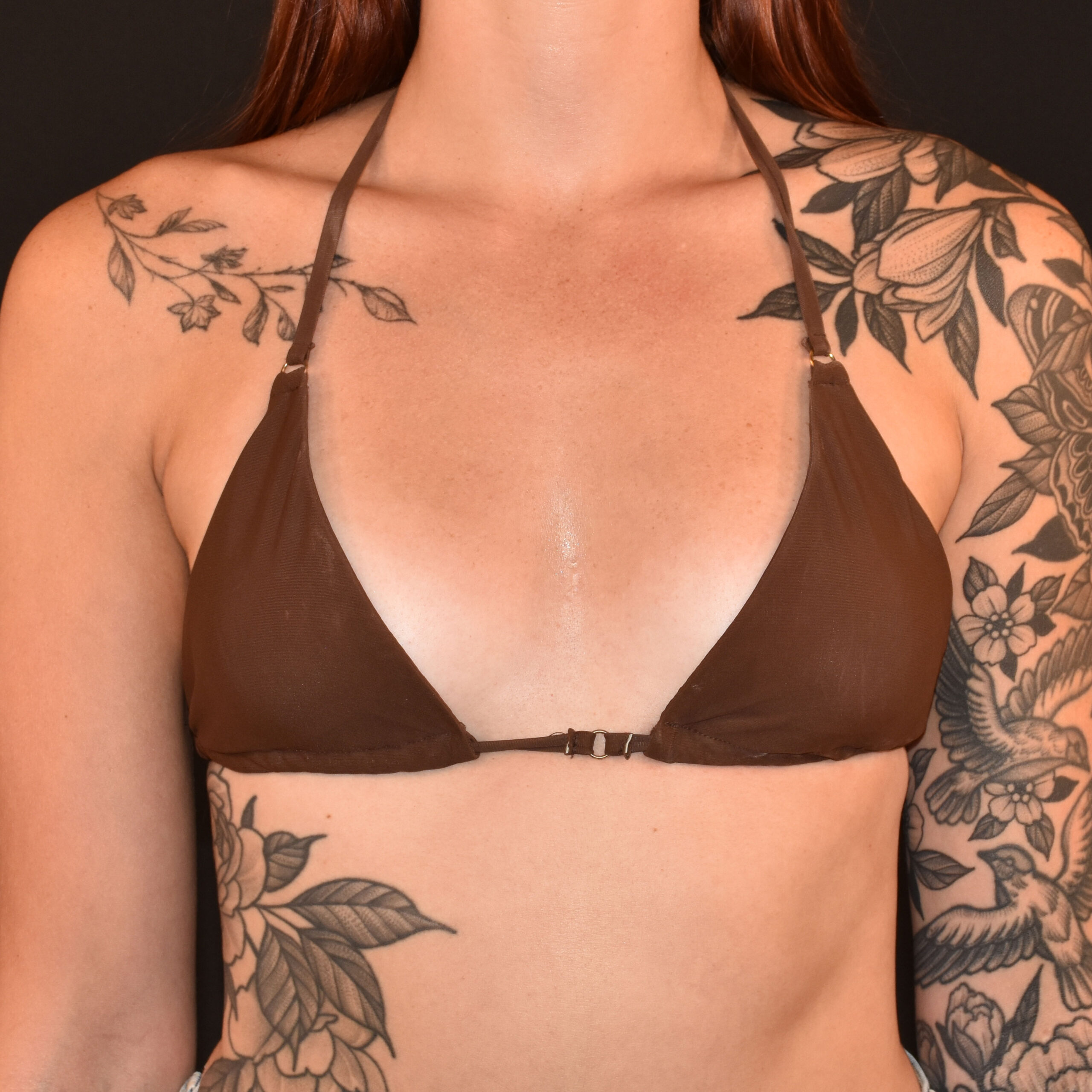 Case--6609 | Before Breast Augmentation 6