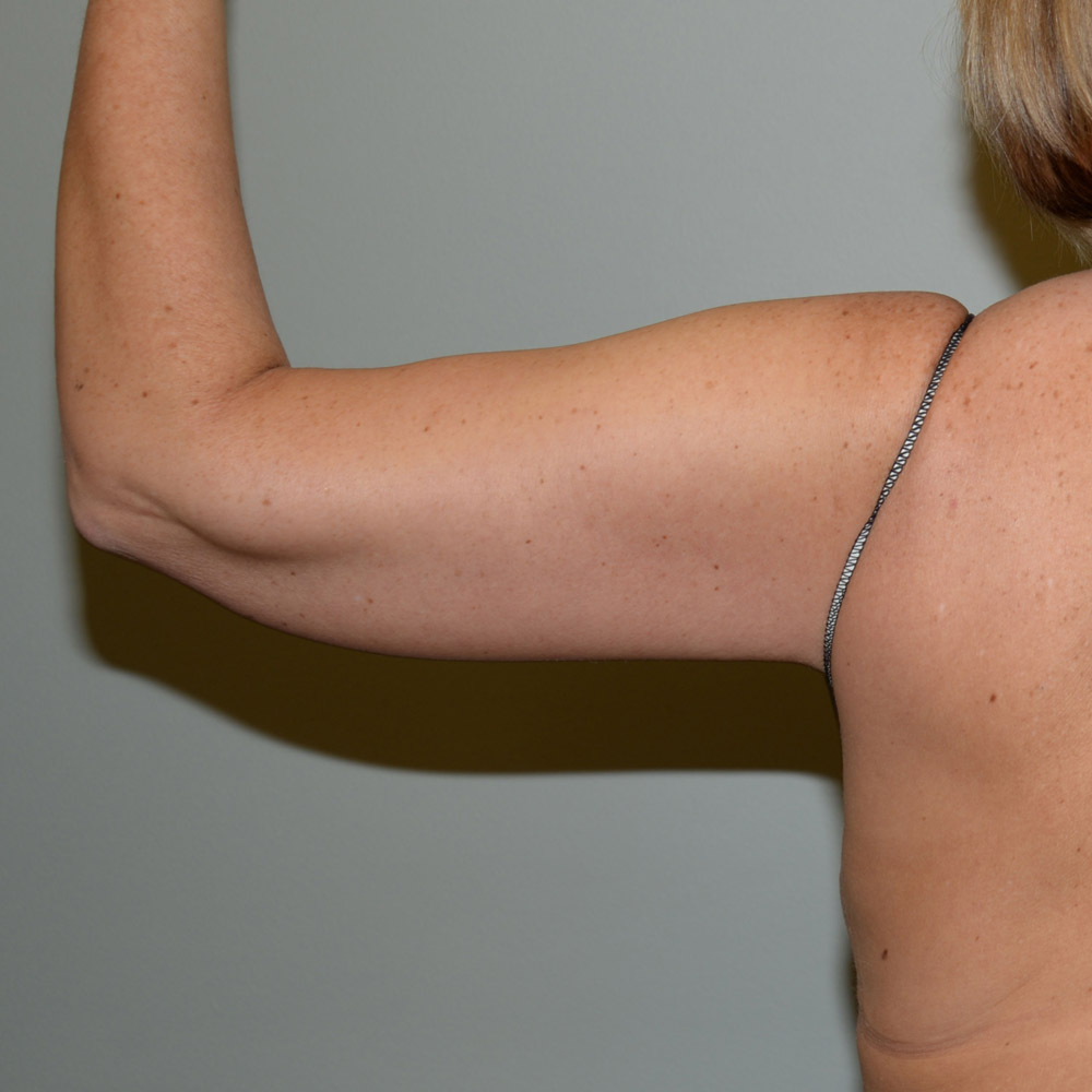 Arm Lift 1385 Back View After Surgery in Lake Oswego & Portland, OR
