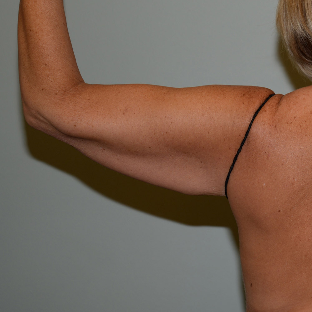 Arm Lift 1385 Back View Before Surgery in Lake Oswego & Portland, OR