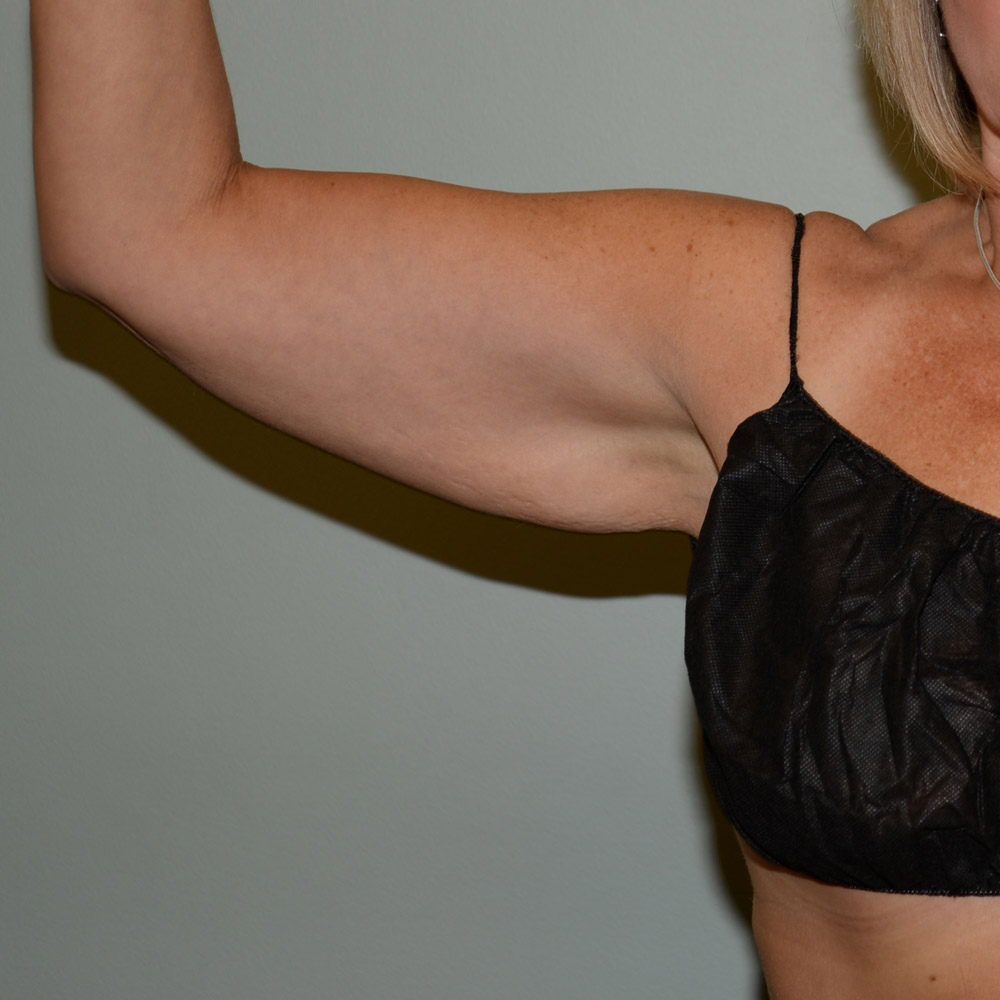 Arm Lift 1385 Front View Before Surgery in Lake Oswego & Portland, OR