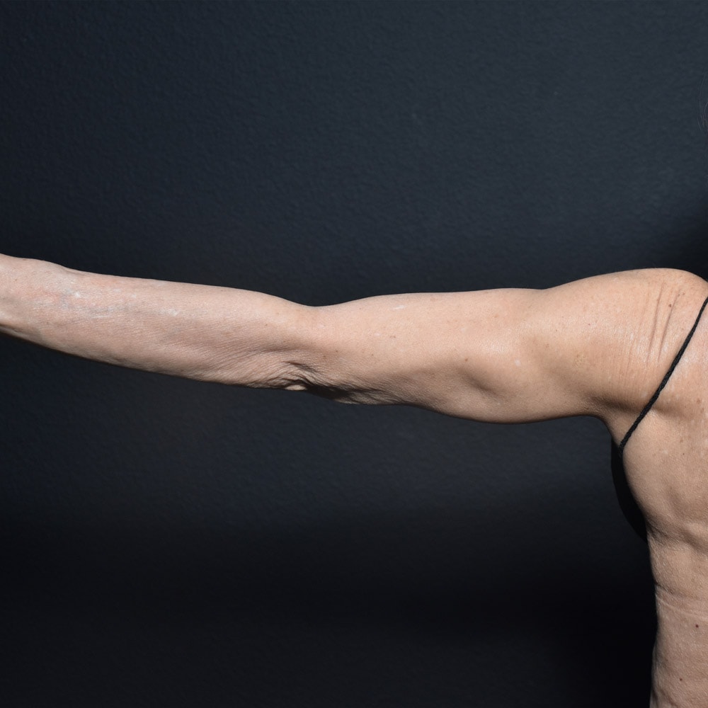 Arm Lift 2411 Back View After Surgery in Lake Oswego & Portland, OR