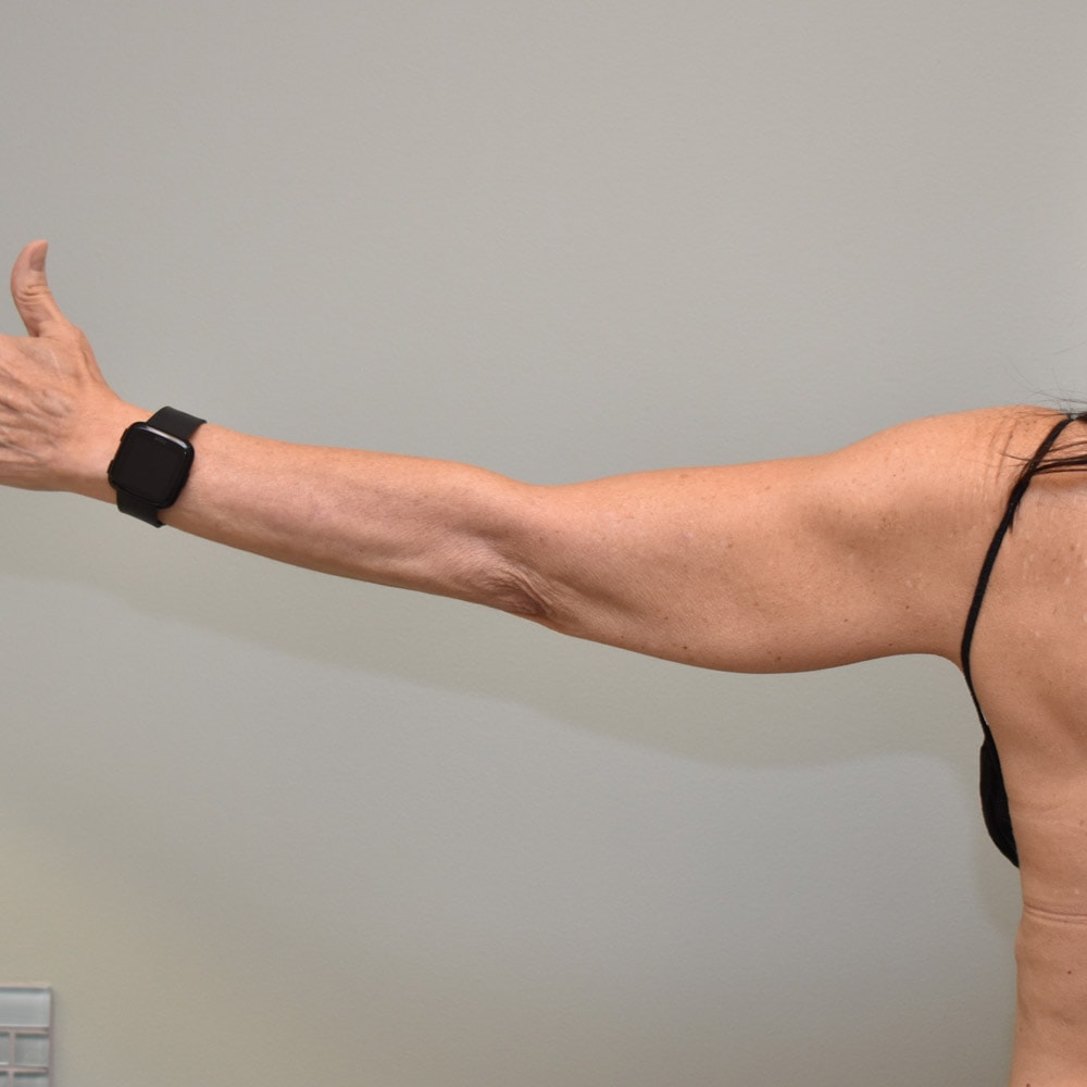 Arm Lift 2411 Back View Before Surgery in Lake Oswego & Portland, OR