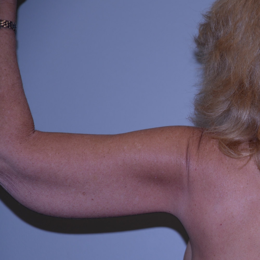 Arm Lift 5404 Back View After Surgery in Lake Oswego & Portland, OR