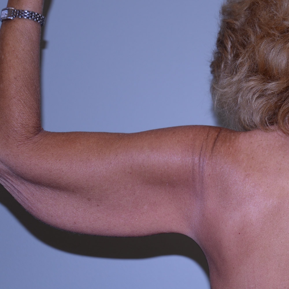Arm Lift 5404 Back View Before Surgery in Lake Oswego & Portland, OR