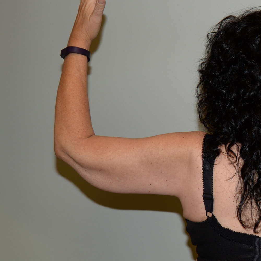 Arm Lift 5926 Back View After Surgery in Lake Oswego & Portland, OR