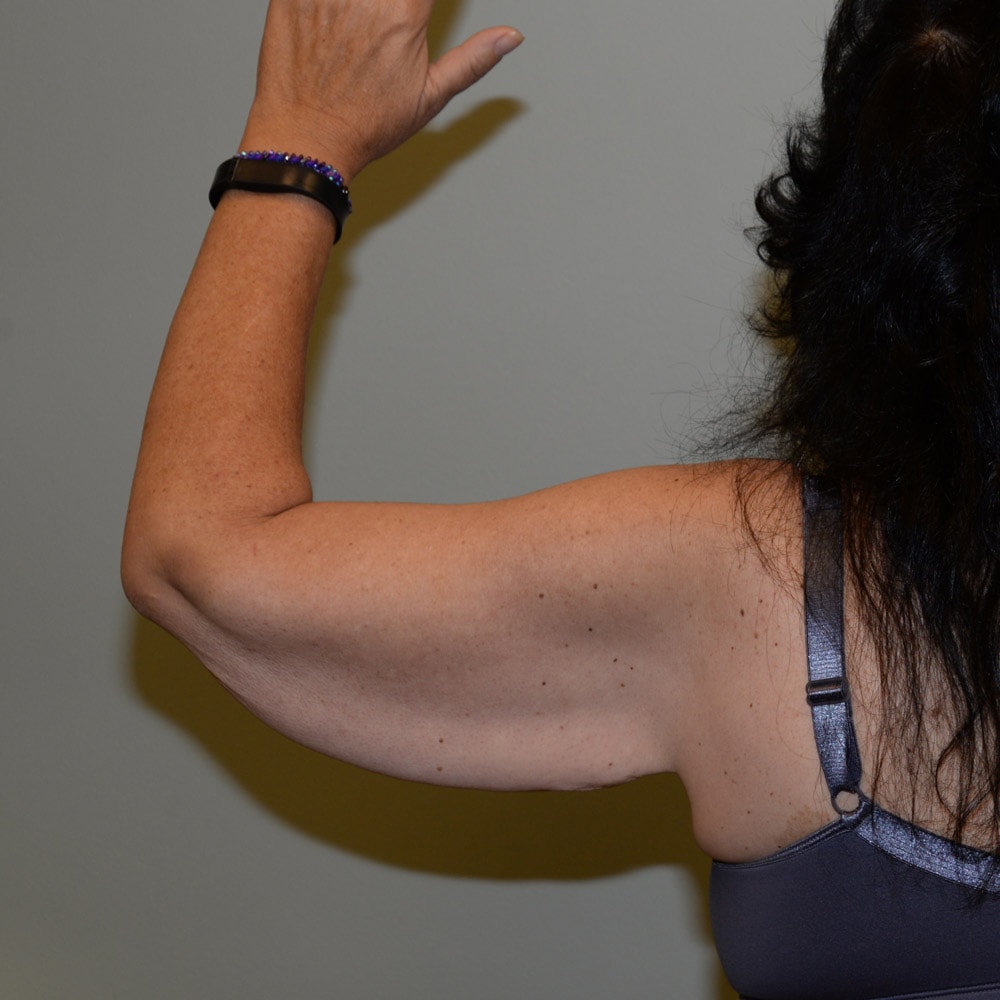 Arm Lift 5926 Back View Before Surgery in Lake Oswego & Portland, OR