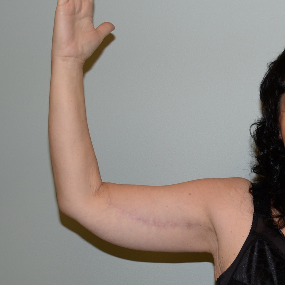 Arm Lift 5926 Front View After Surgery in Lake Oswego & Portland, OR