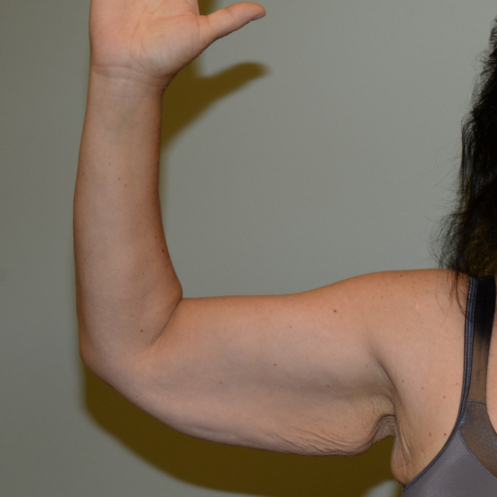 Arm Lift 5926 Front View Before Surgery in Lake Oswego & Portland, OR