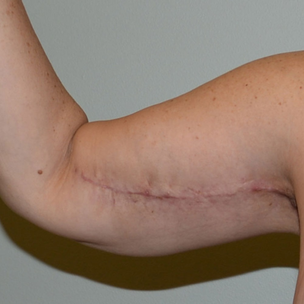 Arm Lift 6667 Front View After Surgery in Lake Oswego & Portland, OR