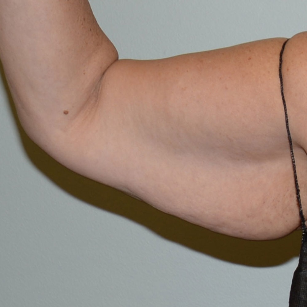 Arm Lift 6667 Front View Before Surgery in Lake Oswego & Portland, OR