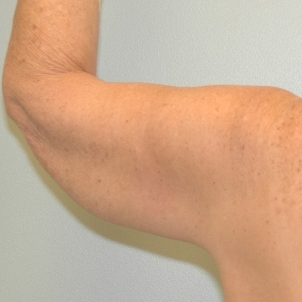 Arm Lift 9315b Back View After Surgery in Lake Oswego & Portland, OR