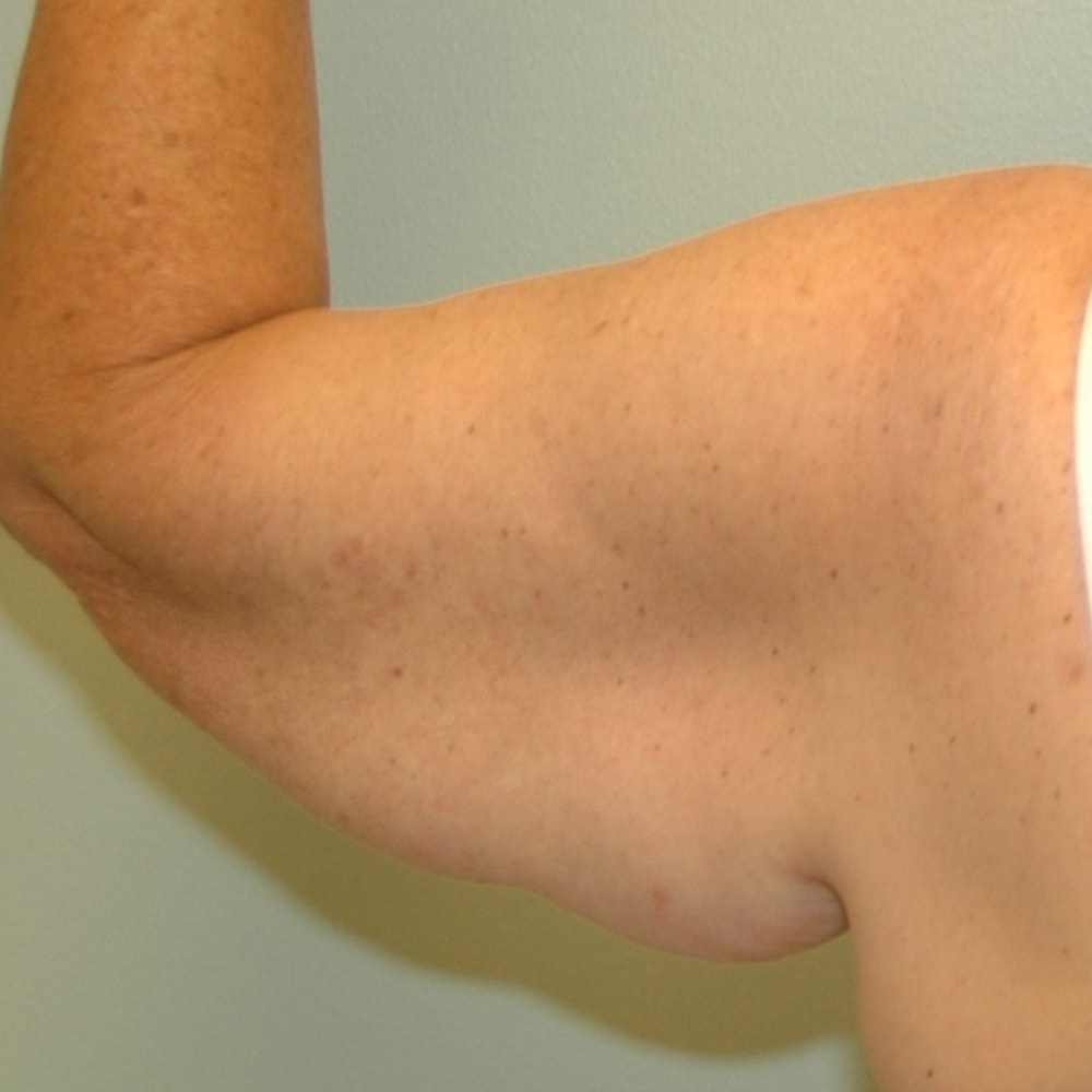 Arm Lift 9315b Back View Before Surgery in Lake Oswego & Portland, OR