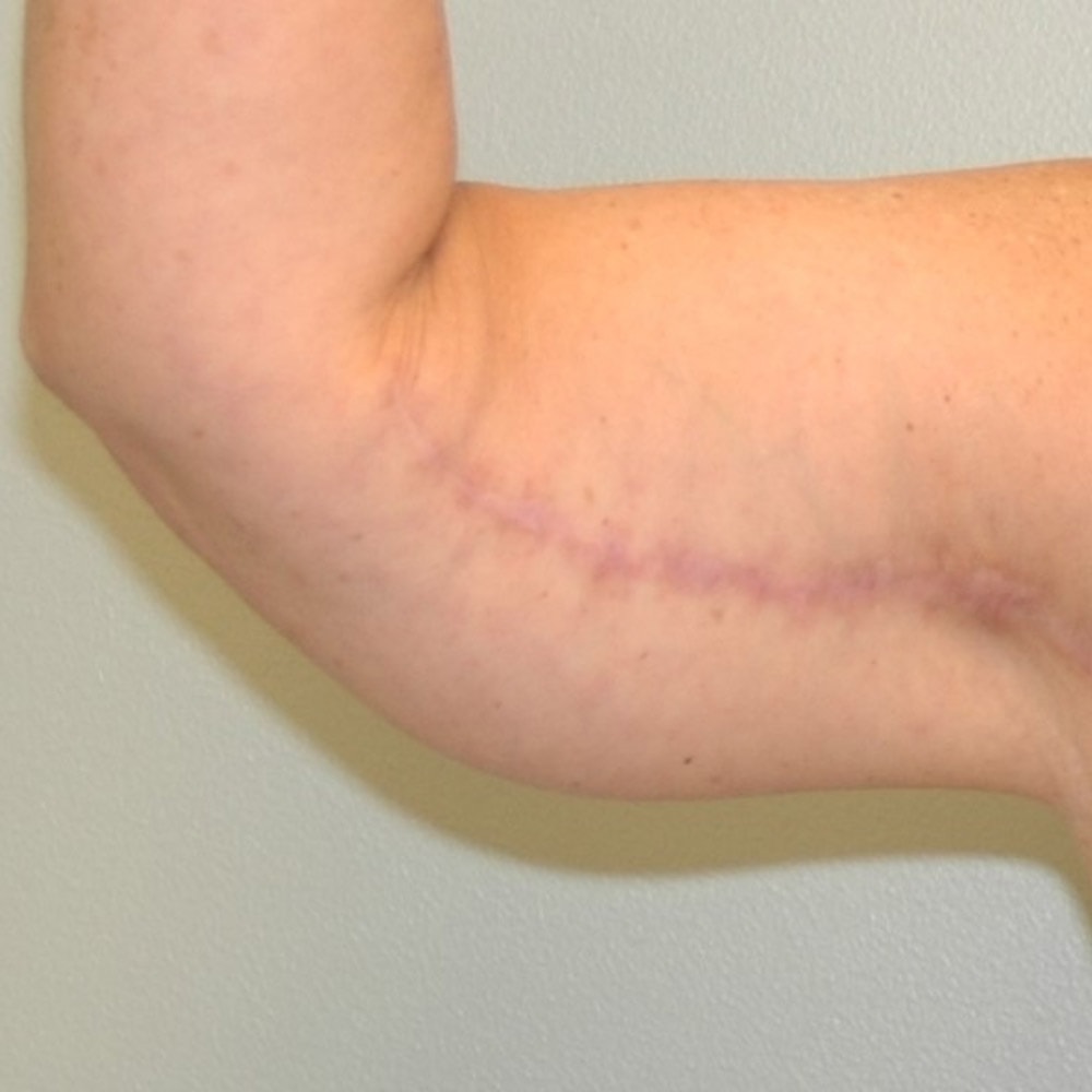 Arm Lift 9315b Front View After Surgery in Lake Oswego & Portland, OR