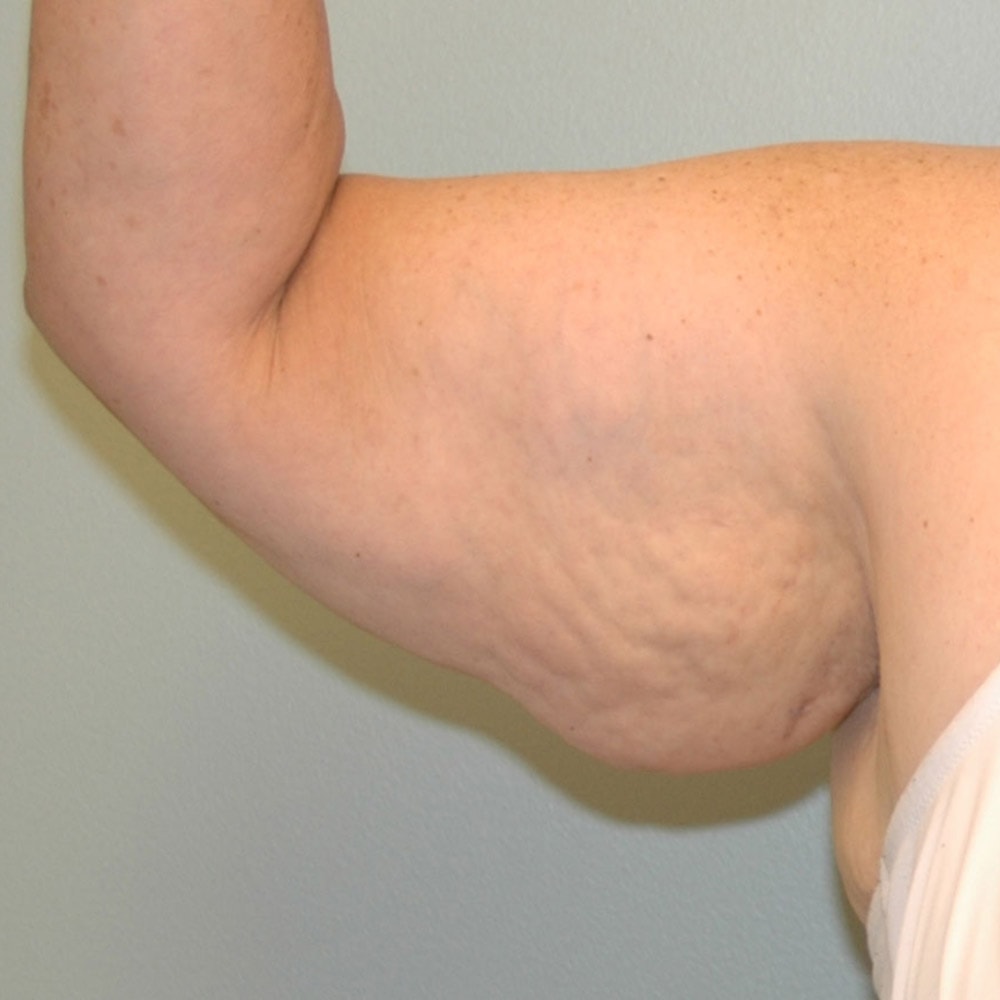 Arm Lift 9315b Front View Before Surgery in Lake Oswego & Portland, OR