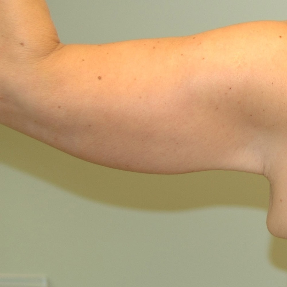 8894 Arm Lift Back View After Surgery in Lake Oswego & Portland, OR
