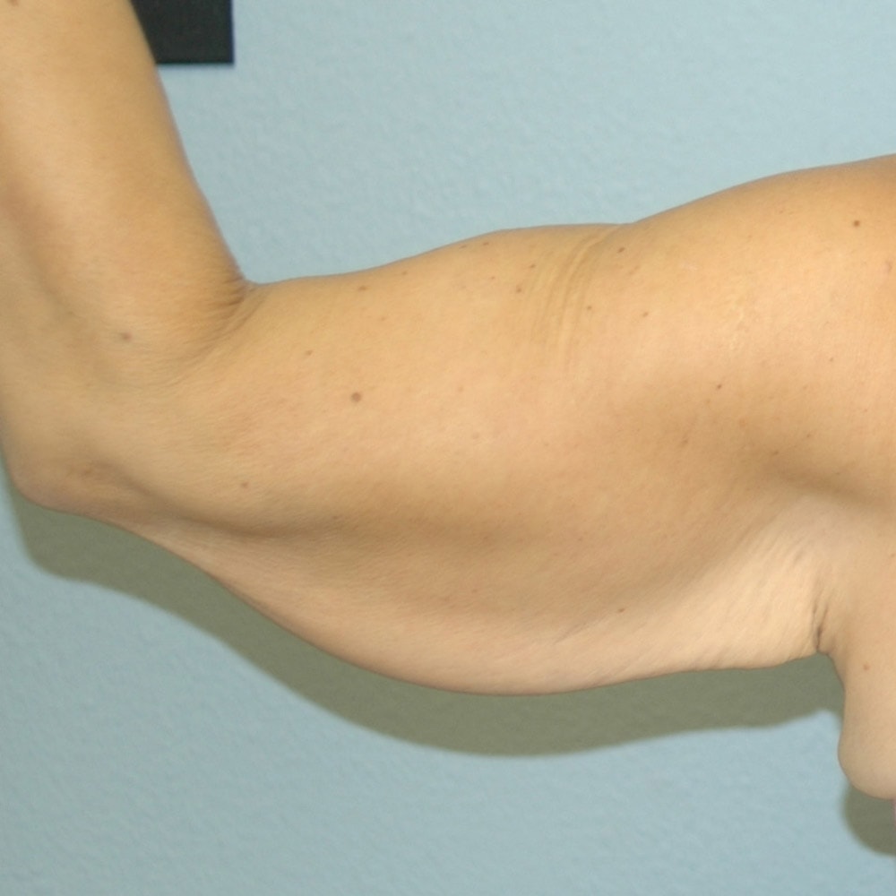 8894 Arm Lift Back View Before Surgery in Lake Oswego & Portland, OR