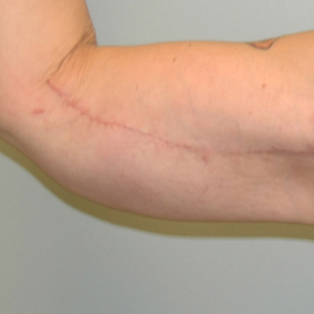 8894 Arm Lift Front View After Surgery in Lake Oswego & Portland, OR
