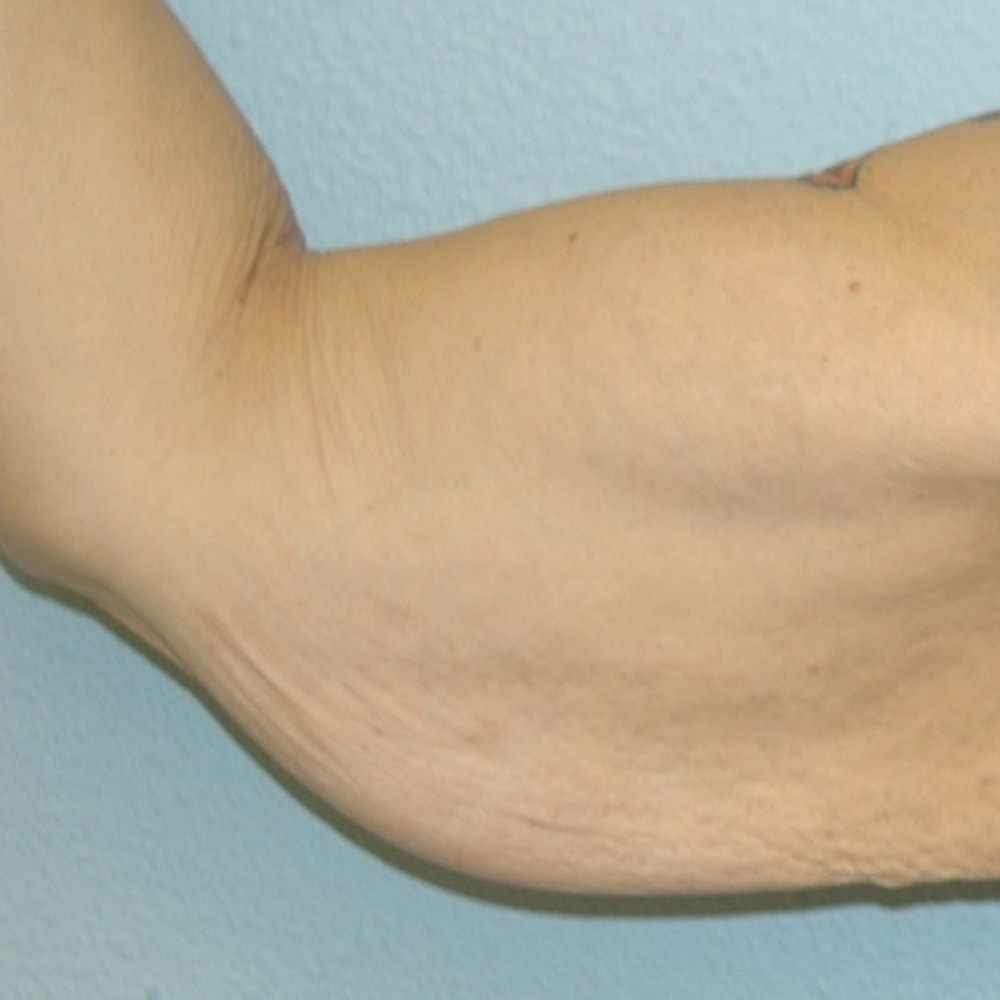 8894 Arm Lift Front View Before Surgery in Lake Oswego & Portland, OR