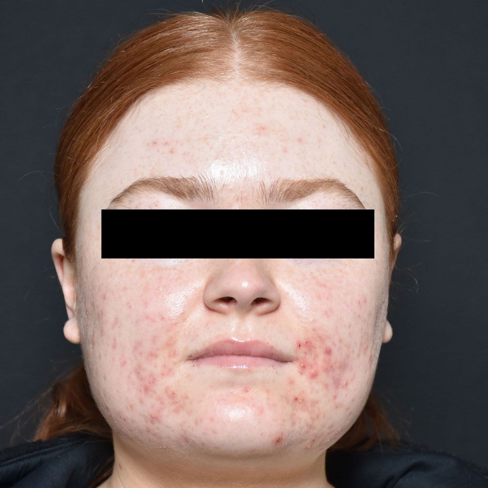 Case--2122 | Before AviClear Acne