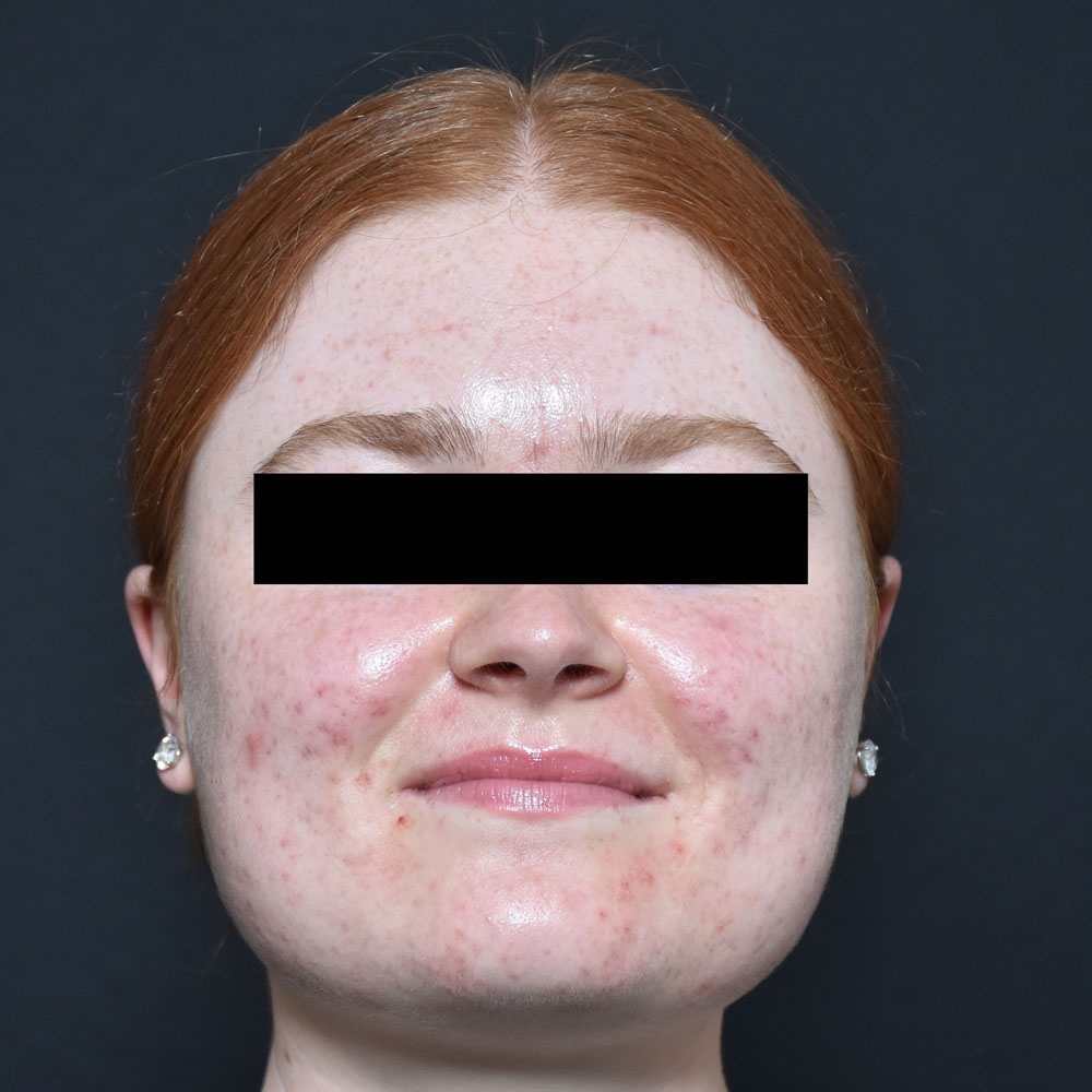 Case--2122 | After AviClear Acne