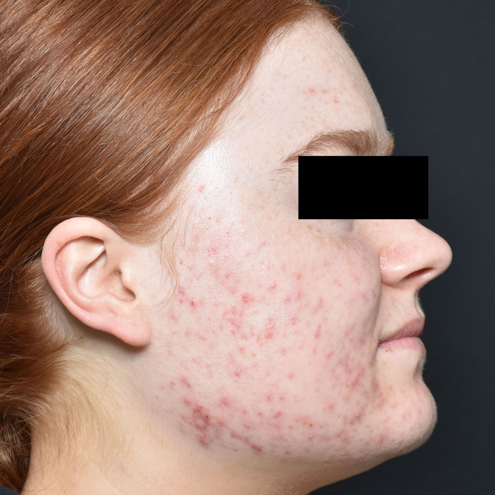 Case--2122 | Before AviClear Acne 2