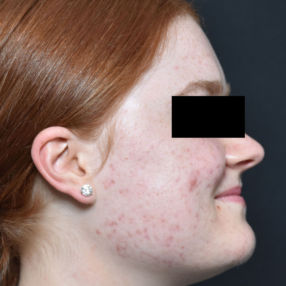 Case--2122 | After AviClear Acne 2