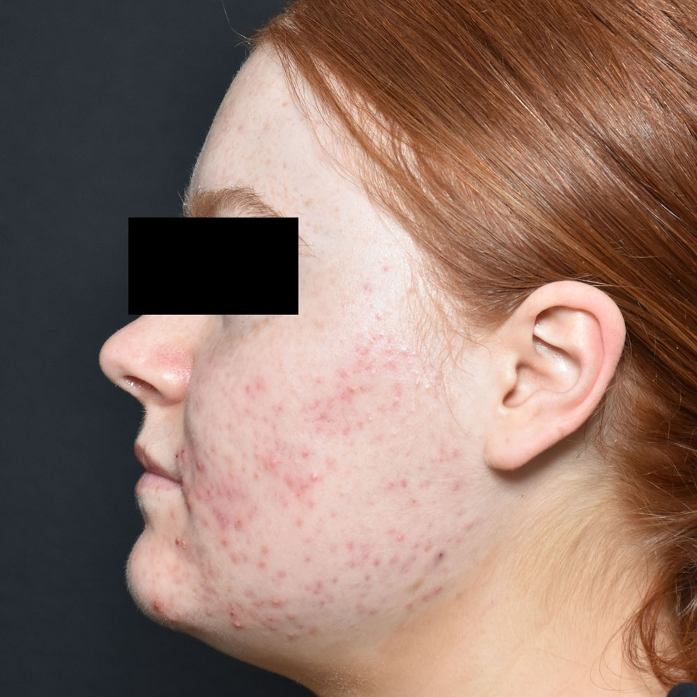 Case--2122 | Before AviClear Acne 3