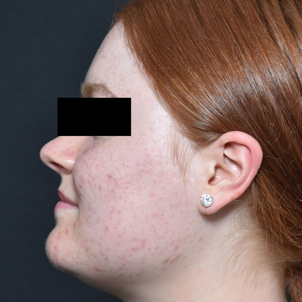 Case--2122 | After AviClear Acne 3