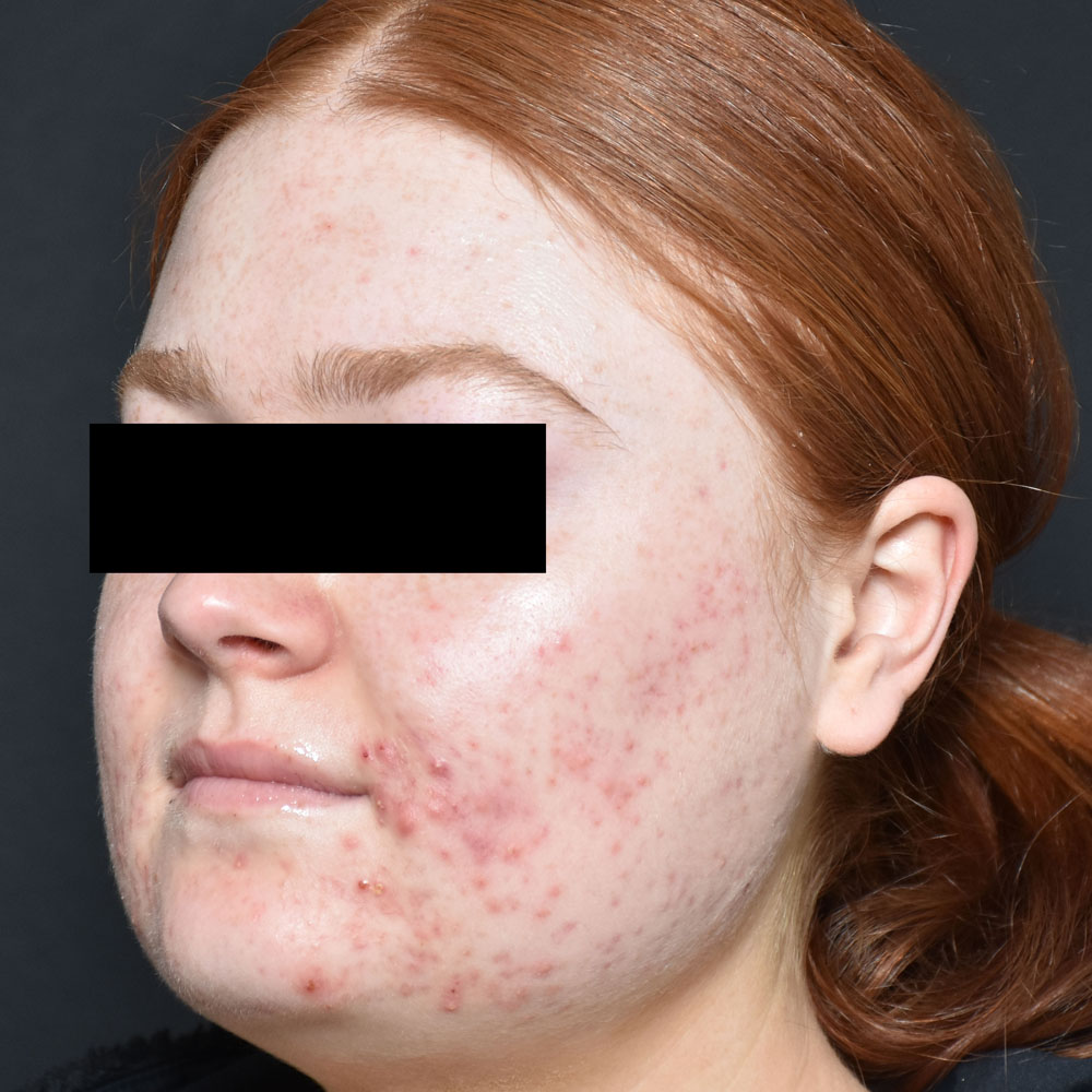 Case--2122 | Before AviClear Acne 4