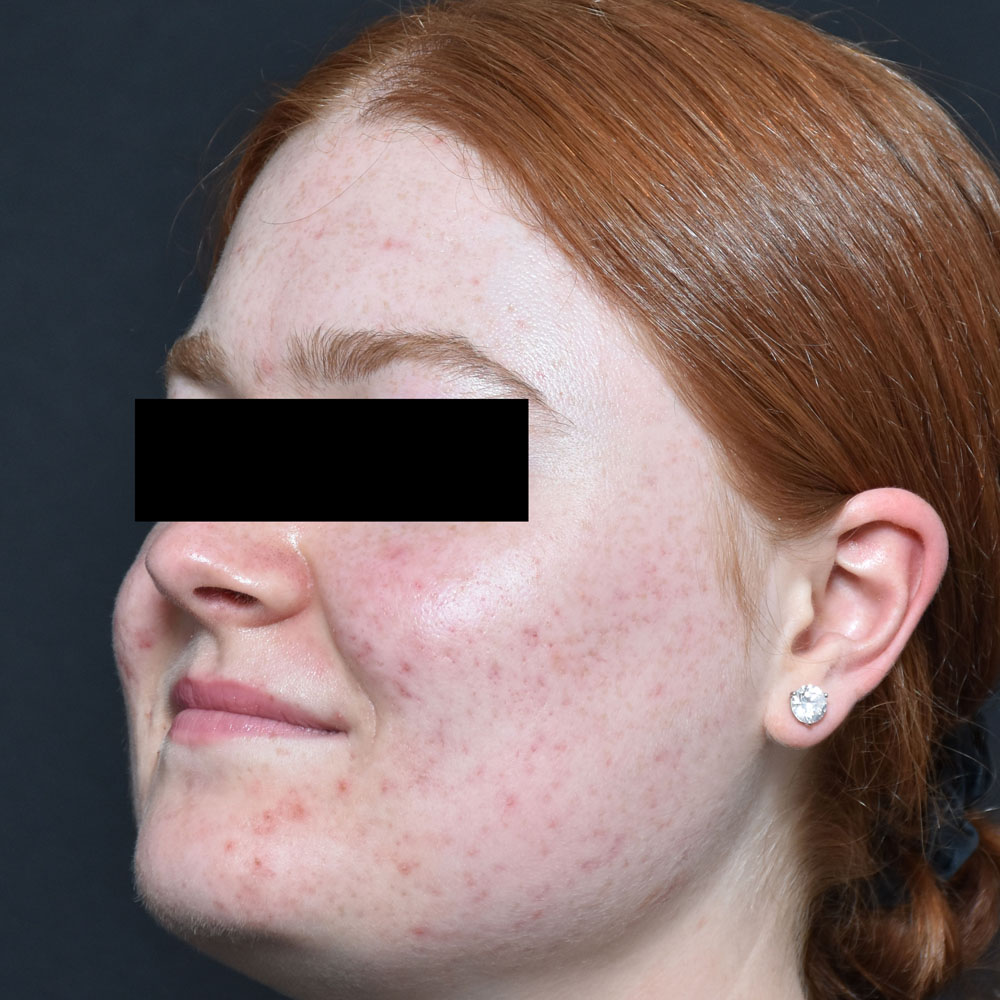 Case--2122 | After AviClear Acne 4