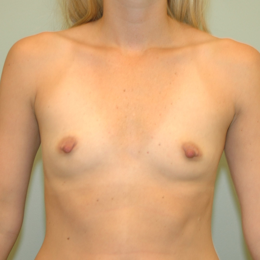 Case--2040 | Before Breast