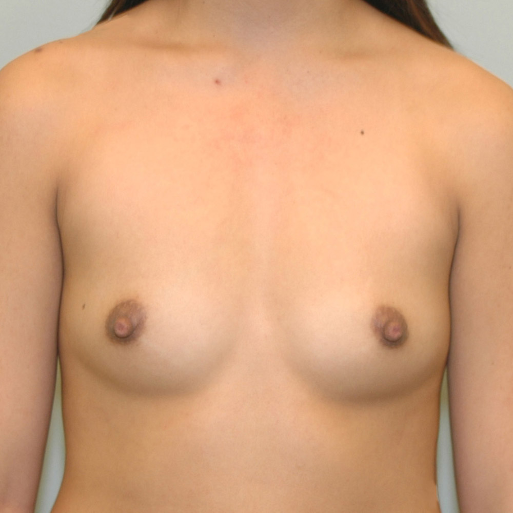 Case--2041 | Before Breast