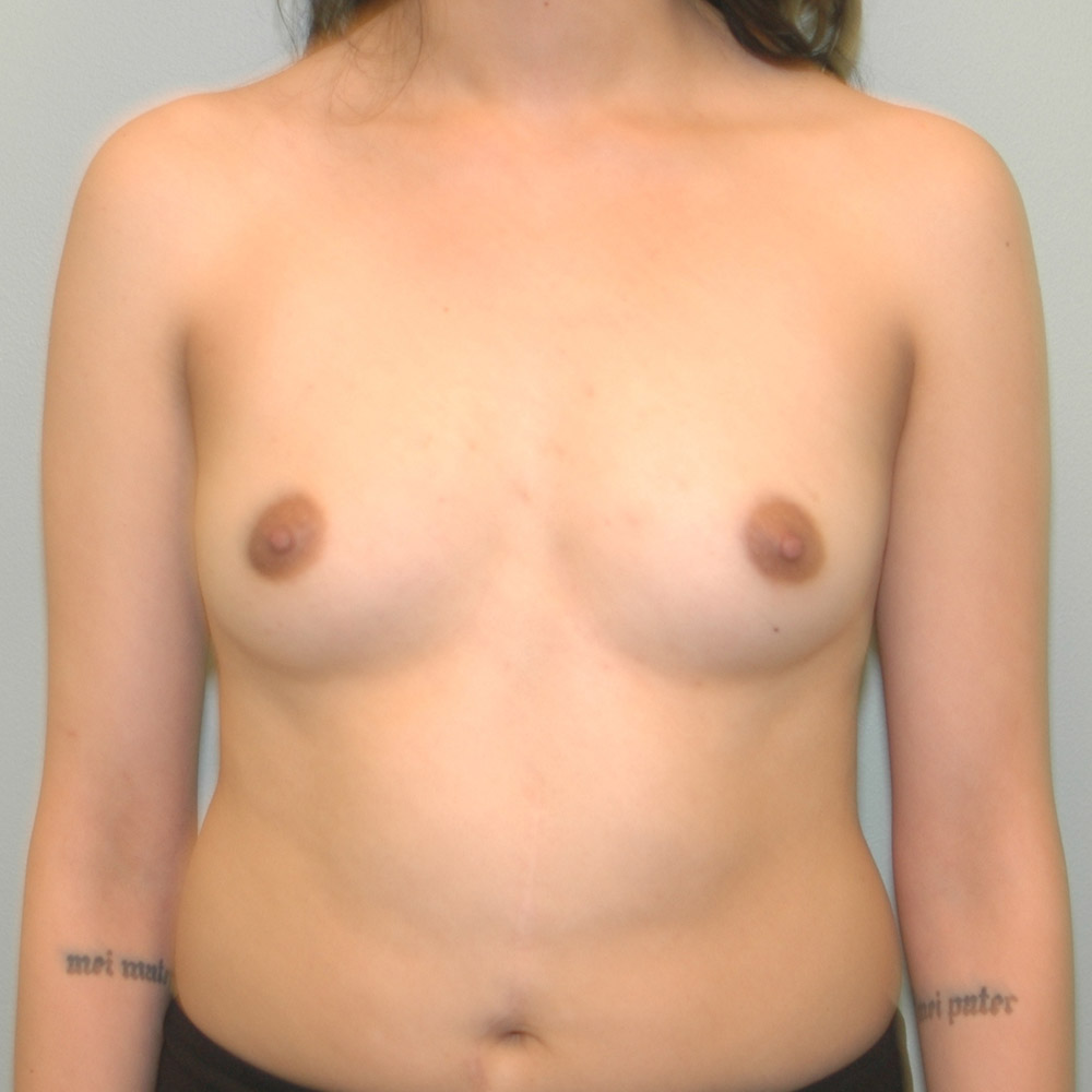 Case--2042 | Before Breast