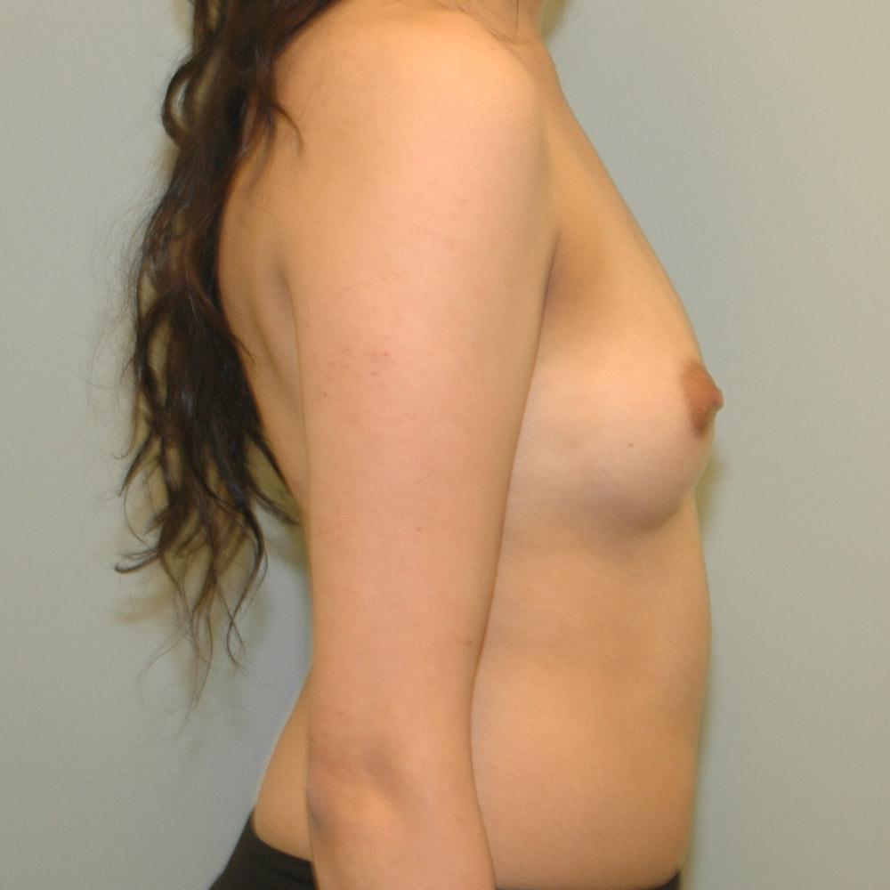 Case--2042 | Before Breast Augmentation 3